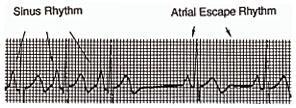 Escape (geç) vurular Olağan pacemaker yetersizdir, bu yüzden daha yavaş bir pacemaker kendi hızında