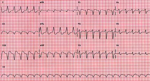 Figur 17: Ventricular tachycardia: Hızlı ve geniş,