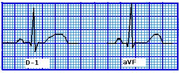 derinliği mm olarak ölçülür. 10 mm = 1.0 mvolt=10 küçük kare 2.