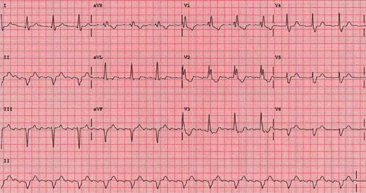 RBBB QRS>0.