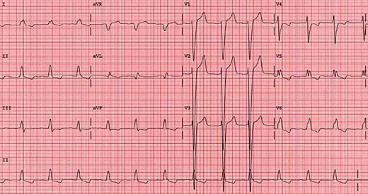 LBBB Eğer QRS>0.