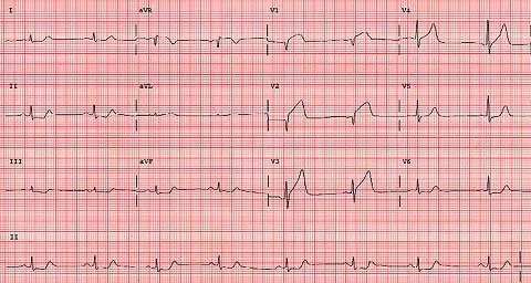 Figur 35: Injury: ST segment elevasyonunu Lead