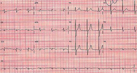 Posterior duvar için, sol ventrikülün anterior ve posterior kısmının depolarizasyonlarını gösteren vektörler ters yöndedir. Bu nedenle V1 de yer alan anterior bir yapının zıttı posterior bir yapıdır.