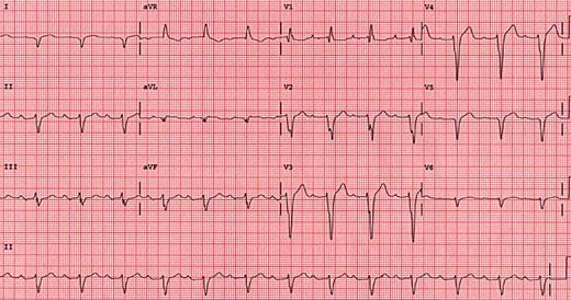 Posterior fasicular blok daha az yaygın (LPFB) Sağ aks deviasyonu, Lead I de S ve Lead III