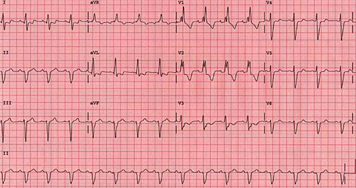 Bifascicular block. Bu 2 veya 3 fasikülün bloke olduğu anlamına gelir. En önemli örnek RBBB ve LAFB tur.