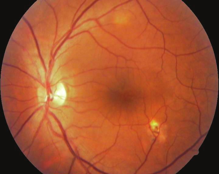 Ön segment muyenesine sğ göz olğn izlenirken sol temporle erin hiperemi ve kemozis izleni. Applnsyon tonometresi ile her iki göze göz içi sını 18 mmhg ölçülü.