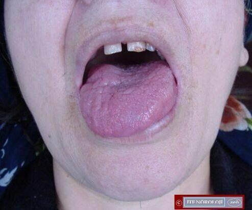 N. Hypoglossus (CN XII) Dil kaslarını hareket ettiren motor sinirdir Tek taraflı lezyonlarda