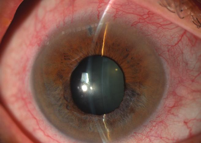 Resim 1: Akut glokom krizi geçirmiş göz Resim 2: Doğuştan (konjenital) glokomlu gözde buftalmus Doğumsal (konjenital) glokomda göz içi basıncı ön kamara açısındaki gelişim bozukluğuna bağlı olarak