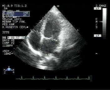 LV LA sağ sol Şekil 6 Ağır MY li bir hastada regürjitan jet alanı(sağda) ve LA alanı(solda) LVDSG ı LVSSS ı IVSSS