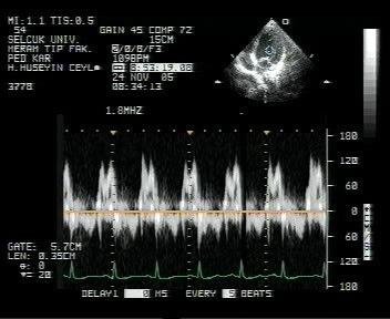 E A E A sağ sol Şekil 8 Mitral akım ölçümleri Sağdaki resim normal bir çocukta mitral akım