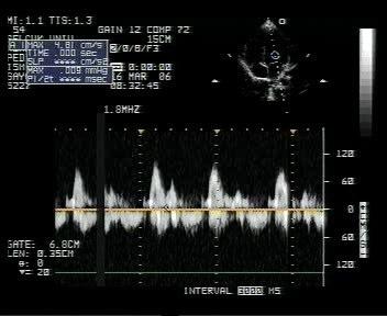 dönmüş) E: Mitral kapağın diyastolik erken doluş peak velositesi, A: Mitral kapağın diyastolik