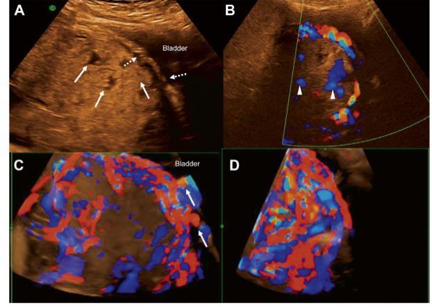 Myometrial kalınlık Plasental lakünler Retroplasental hipoekoik alan kaybı Mesane duvar