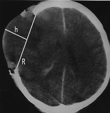 Bilateral intrakranyal lezyonların varlığında, GKS=3 ve beyin sapı refleksleri alınamıyorsa bu cerrahi teknik uygulanmadı ve bu olgular serimize katılmadı.