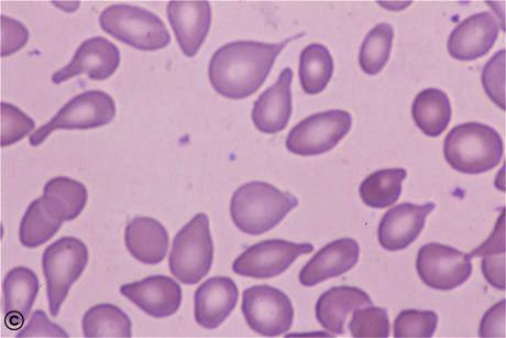 BM 3. Tumours of