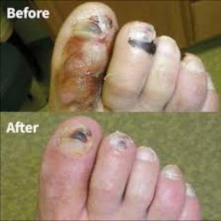 Bal Kullanımı (Apiterapi) Yüzyıllardır yara iyileşmesinde kullanımda Yanık, diyabetik ayak, dekübit yaraları Etkileri; Antimikrobiyal etki Granülasyon oluşumu Epitelizasyonu İnflamasyonu Ödem