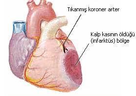 4. Kardiyovasküler Sisteme İlişkin Tanı Terimleri Acute myocardial infarction/ Myocardial Infarction (akut miyokard enfarktüsü / miyokard enfarktüsü AMI - MI): Kalp krizi.