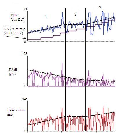 0 cmh 2 O/µV EAdi Maksimum olana kadar ventilasyon NAVA düzeyi yavaş