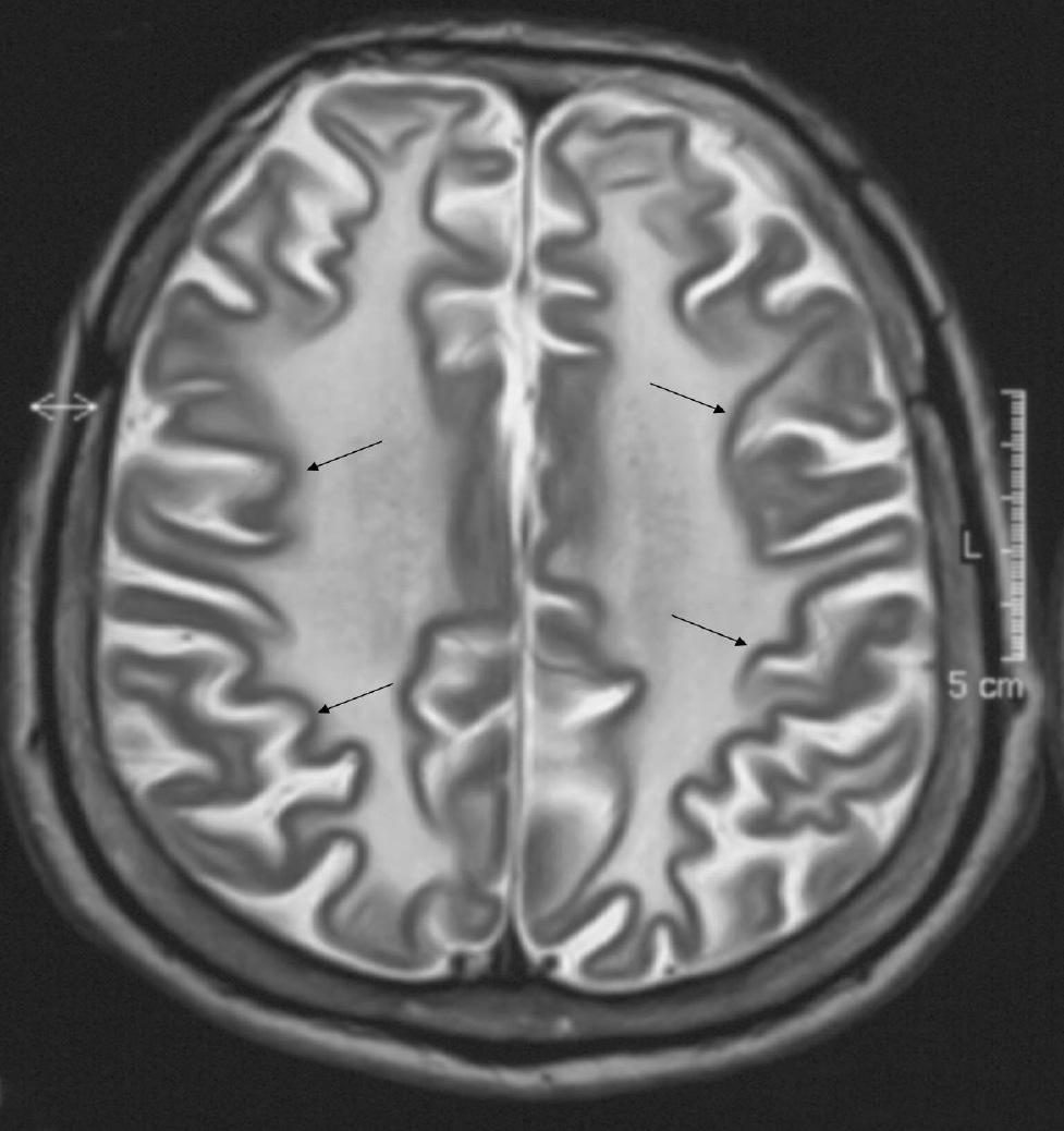fiekil 1a. Sentrum semiovale düzeyinden geçen T2 a rl kl kesitte her iki serebral hemisferde tüm beyaz maddeyi tutan anormal sinyal yo unlu u art fl izlenmektedir.