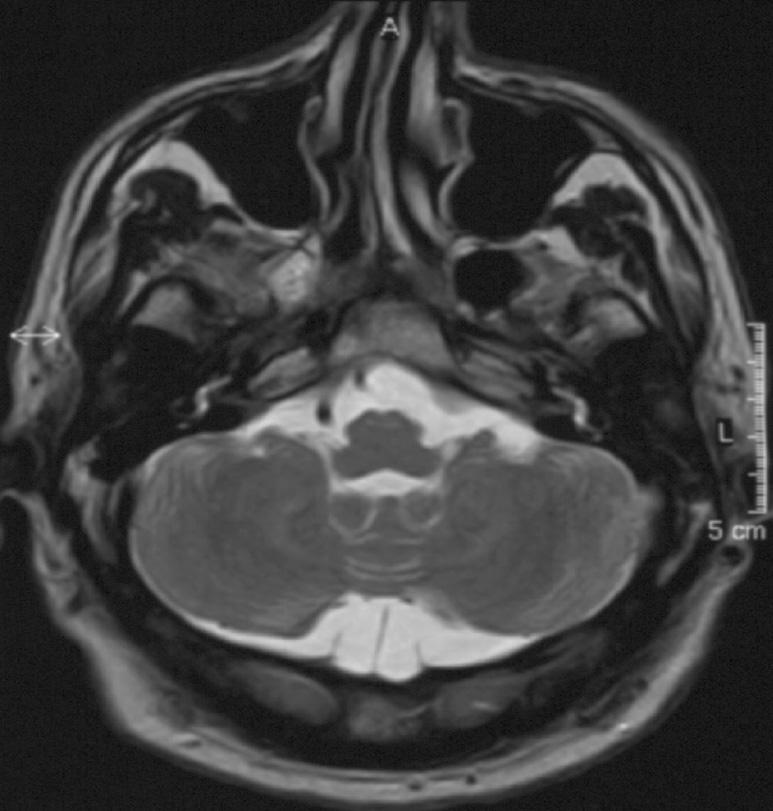 5 Baz hastalarda geç evrede ekstrapiramidal semptomlar (distoni, atetoz vb.) geliflebilir. S kl kla erken yaflta bafllayan nöbetler vard r ve antiepileptik ilaç (AE ) tedavisine cevapl d r.