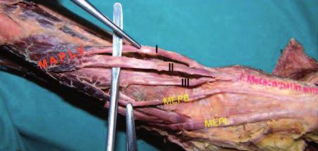 Anatomy tendonlar ise asemptomatik kalabilir, postmortem otopsi ya da diseksiyonlarda rastgele karşımıza çıkabilirler.