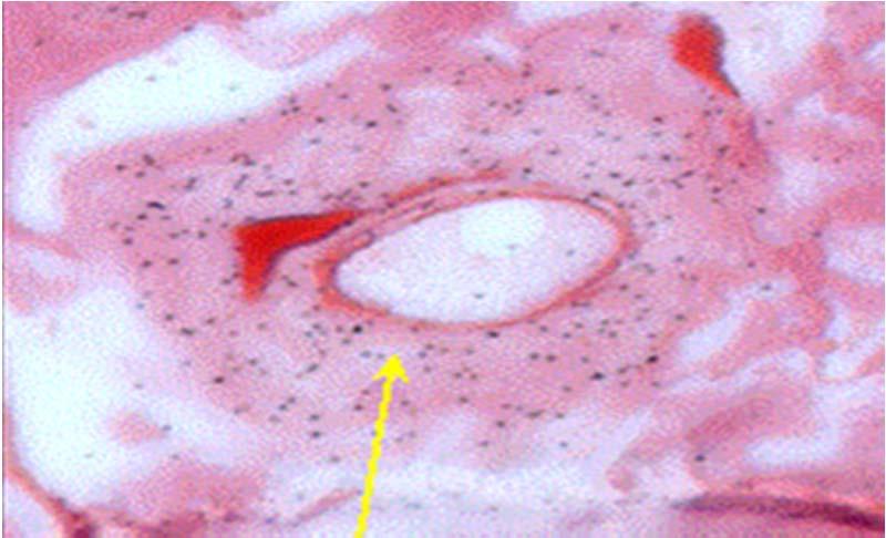 Peritonda değişiklikler Mezotelyal hücre kaybı Submezotelyal alanda
