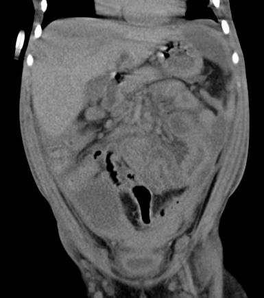 OLGU 2 Görüntüleme Abdominal US: Karaciğer inferiorunda batın sağ alt kadrana doğru uzanım