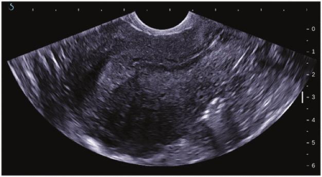 A SEÇİLMİŞ MAKALELER 1- Adenomyozis Tanısında Ultrason Makaslama Dalga Elastografisinin Değeri. Value of ultrasound shear wave elastography in the diagnosis of adenomyosis.