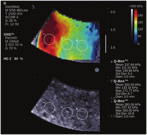 Şekil 3 : Doğrulanmış adenomyozisi olan bir hastada myometriumun kayma dalga elastografisi (A alt grup) (ZOOM).