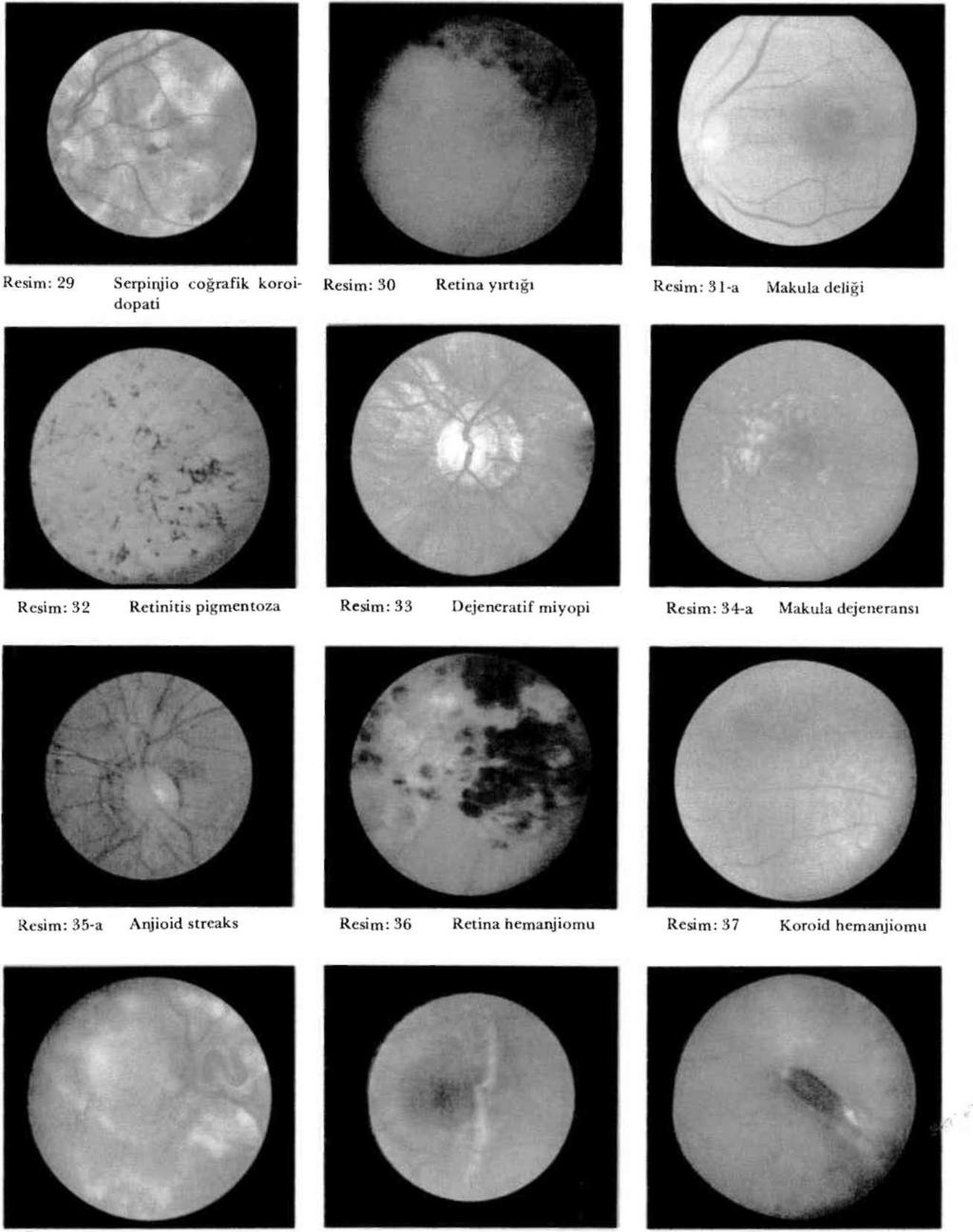 164 FUNDUSUN OFTALMOSKOPÍK VE ANJİOGRAFÎK GÖRÜNÜMÜ Resim: 38-a