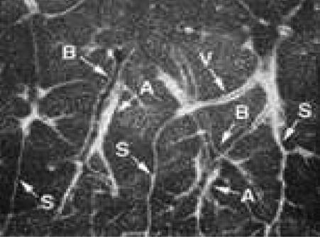 Bronşiyolit tipi Etiyoloji Histoloji YRBT İnflamatuar İnfeksiyöz Viral, mikoplazma, mikobakteri Bronşiyol duvarlarının inflamatuar Sentrilobüler nodüller, tomurcuklanan hücrelerce infiltrasyonu ağaç