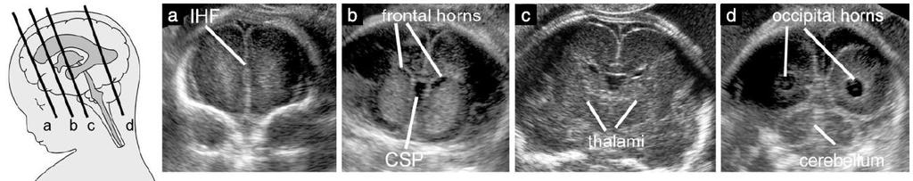 3- Fetal Nörosonogram Kraniyal Koronal Kesitler Transfrontal plan; Anterior fontanel üzerinden görüntülenir. Ortahat interhemisferik fissure(ihf) kesintisiz.