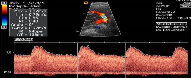 2- Öneriler Uterin Arter Doppleri için uygun teknik nedir?