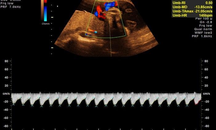 Fetal uç, plasental uç ve serbest kord ölçümleri