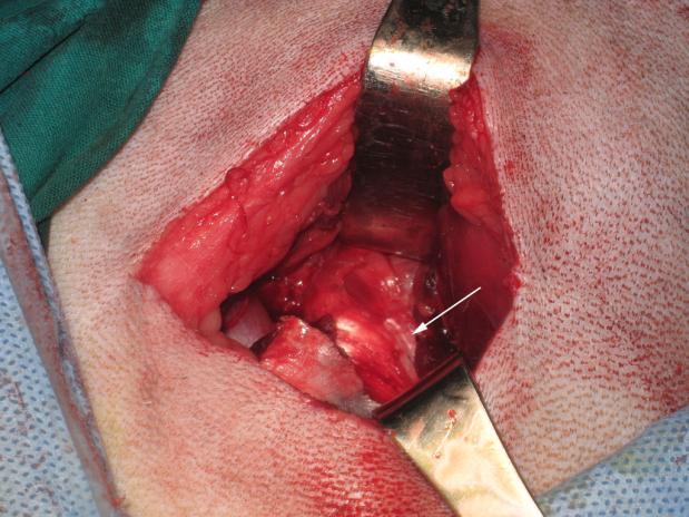Positioning of the patient Hasta genel anestezi altında iken gref alınacak kranial iliak kanat üzerindeki donör bölgenin ve asıl operasyon bölgesi olan sol trohanterik alanın traş ve dezenfeksiyonu