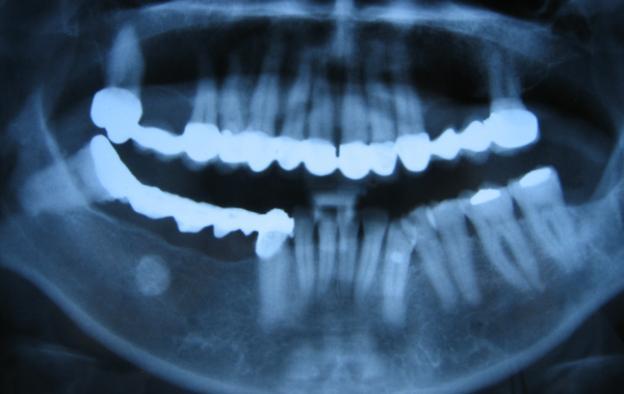 EÜ Dişhek Fak Derg 2012; 33(1): 38-42 Anamnezinde dişsiz bölgeye köprü talebi ile özel bir dişhekimine gittiği ve bölgenin analizi için kliniğimizin önerildiği öğrenilen hastanın ağız açıp kapama ve