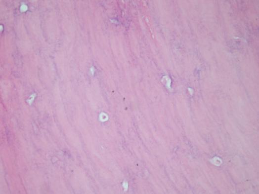 Olguya ait lezyonun histopatolojik görüntüsü (H&E,X20) TARTIŞMA Osteomların gerçek prevalansı bilinememektedir.