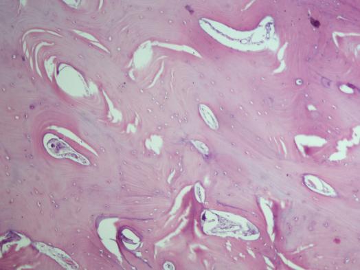 5 Periferal osteomlar genellikle başta frontal sinüsler olmak üzere sırasıyla etmoidal ve maksiller sinüslerde gözlenmektedir.