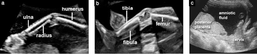 Resim 6 Fetusun kolu, bacağı ve plasentasının ultrasonografi görüntüsü. Teknik nedenlerle görüntülenememesi haricinde kol ve bacağın varlığı ya da yokluğu rutin olarak kayıt edilmelidir (a, b).