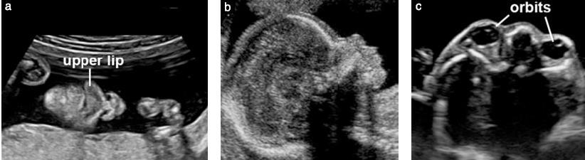 Resim 3 Fetusun yüzünün ultrasonografi incelemesi. Ağız, dudaklar ve burun klasik olarak koronal kesitte incelenir (a).