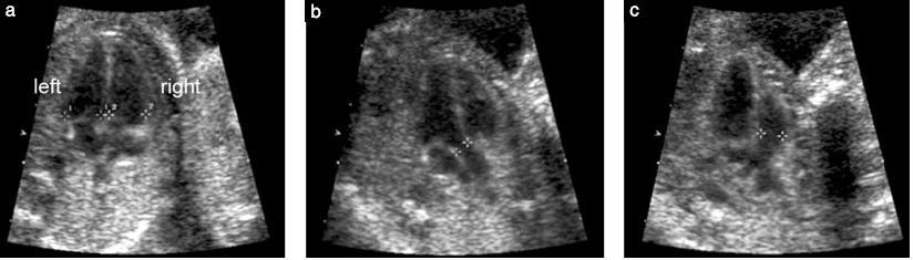 Resim 4 Fetusun kalbinin temel ve genişletilmiş temel görüntüleri. Temel kalp muayenesiyle ilgili görüntü dört oda (a) kesitinde her iki ventrikül diastol sonundayken (işaretleyiciler) elde edilir.