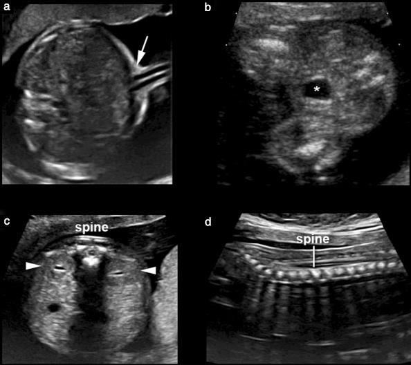 Normal fetuslarda, ait oldukları ventrikülden çıktıktan sonra birbirlerini çaprazlarlar. Resim 5 Göbek kordonunun fetusa giriş yeri, mesane ve A. umbilicalis ler, böbrekler ve omurga.