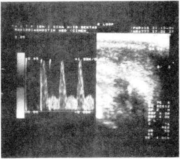 ÖZCAN ve Ark. VASKÜLOJENİK EMPOTANSIN DEĞERLENDİRİLMESİNDE RENKLİ DOPPLER GÖRÜNTÜLEME (RGD) 311 (ortalama 8.02) arasında değişmekteydi.