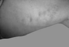 Hastaların hepsine safenofemoral bileşkede safen vende reflü olduğunu ve derin ven trombozu (DVT) nun olmadığını göstermek için doppler ultrasonografi yapıldı (Şekil 2).