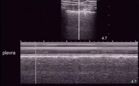 Toraks USG Toraks USG değerlendirmesi Plevral sıvı, hemotoraks
