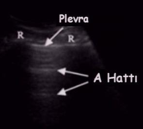 Normal Plevral Kayma Sesi (PSS) 6.