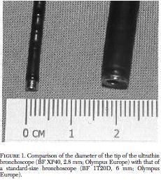 Minimal invaziv yontemler: Bronkoskopi Ultrathin Bronkoskopi Prototype Olympus BF XP40; Dis capi 2.8 mm, working channel 1.