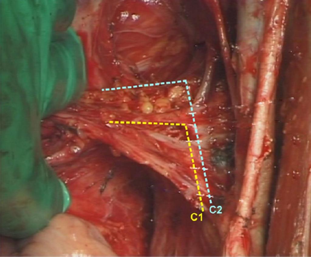 Sinir koruyucu cerrahinin gelişimi Cibula, 2011 Q-M sınıflandırma sistemindeki rezeksiyon tiplerinin vertikal