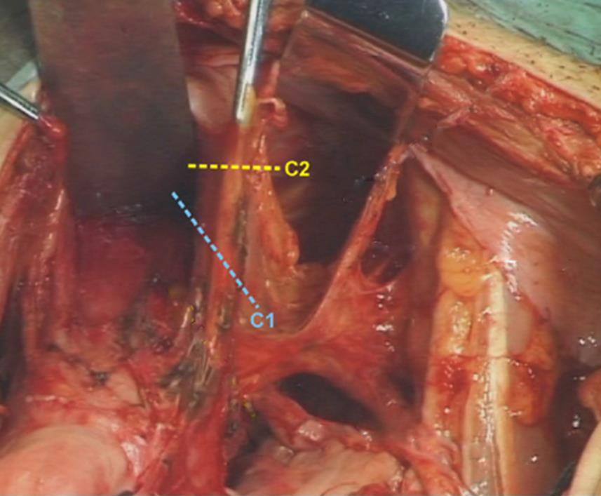 Sinir koruyucu cerrahinin gelişimi Querleu, 2017 Ventral (anterior) parametrium