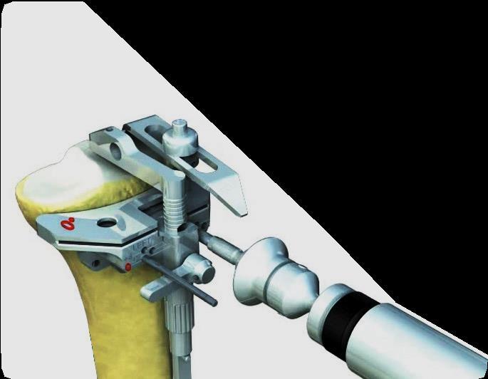 3. Tibial Kesiğin uygun yüksekliği tibial platonun en sağlıklı kısmının alt noktasına yerleştirilmesi gereken iki uçlu Tibial Uç (Stylus)