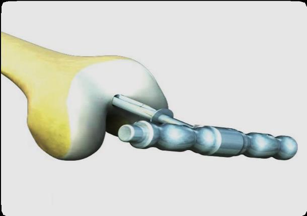 Distal femur delme işlemi yapıldıktan sonra modüler bir kulp takılmış olan femoral intramedüler çubuk delik içerisine yerleştirilir.
